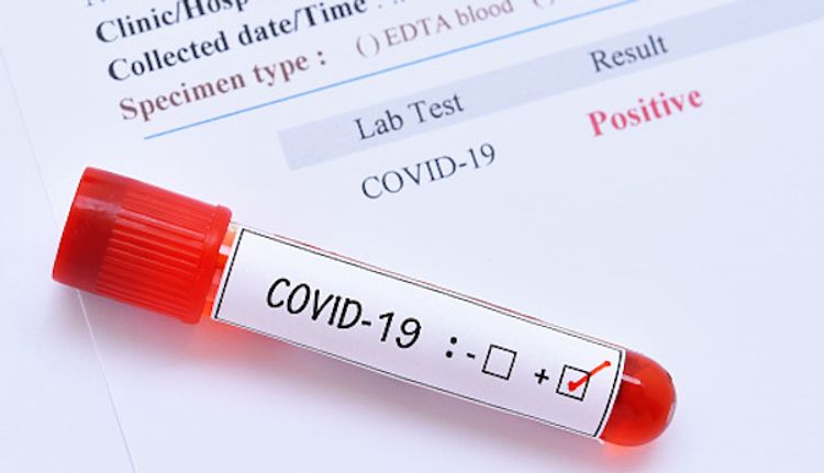 Global coronavirus cases reaches 19 million