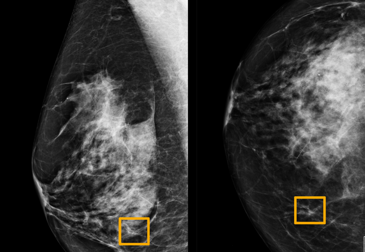 Study finds Google system could improve breast cancer detection