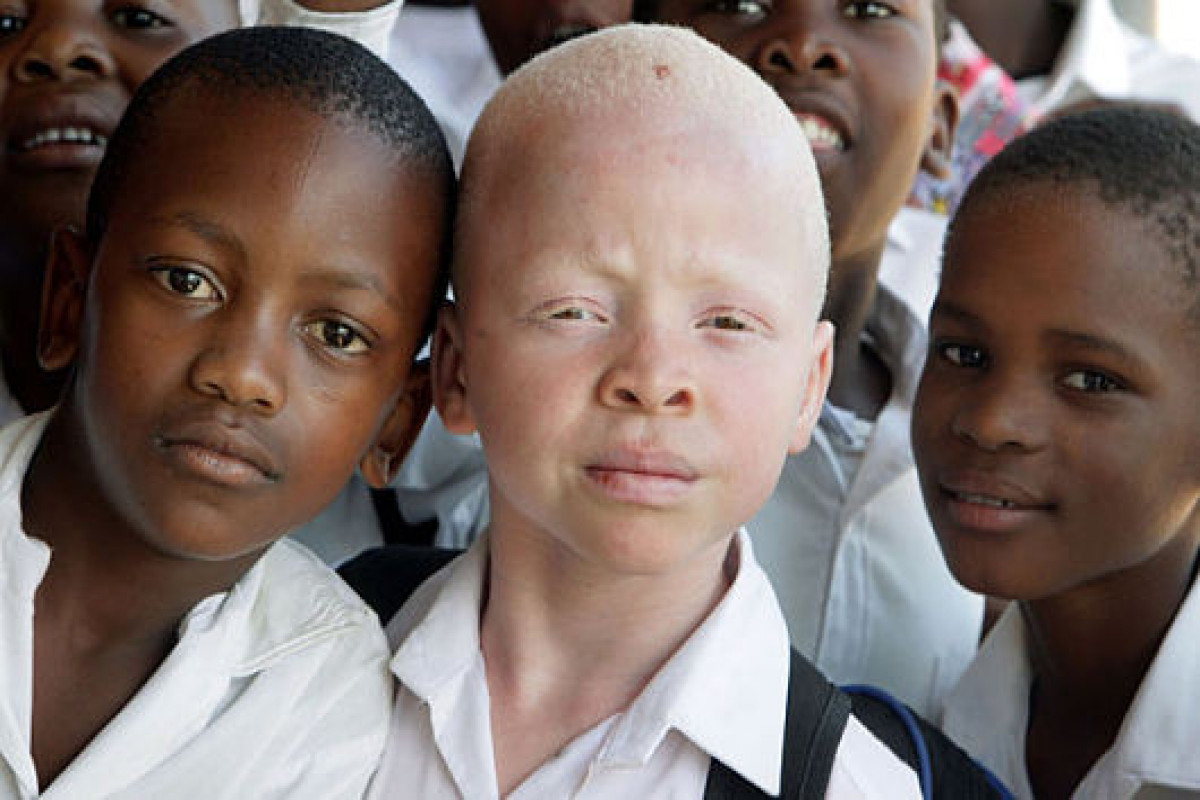 Tanzania pledges full protection of albinos