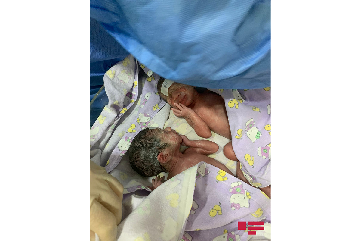 В настоящее время в Азербайджане есть новорожденный с самым маленьким весом-524 грамма