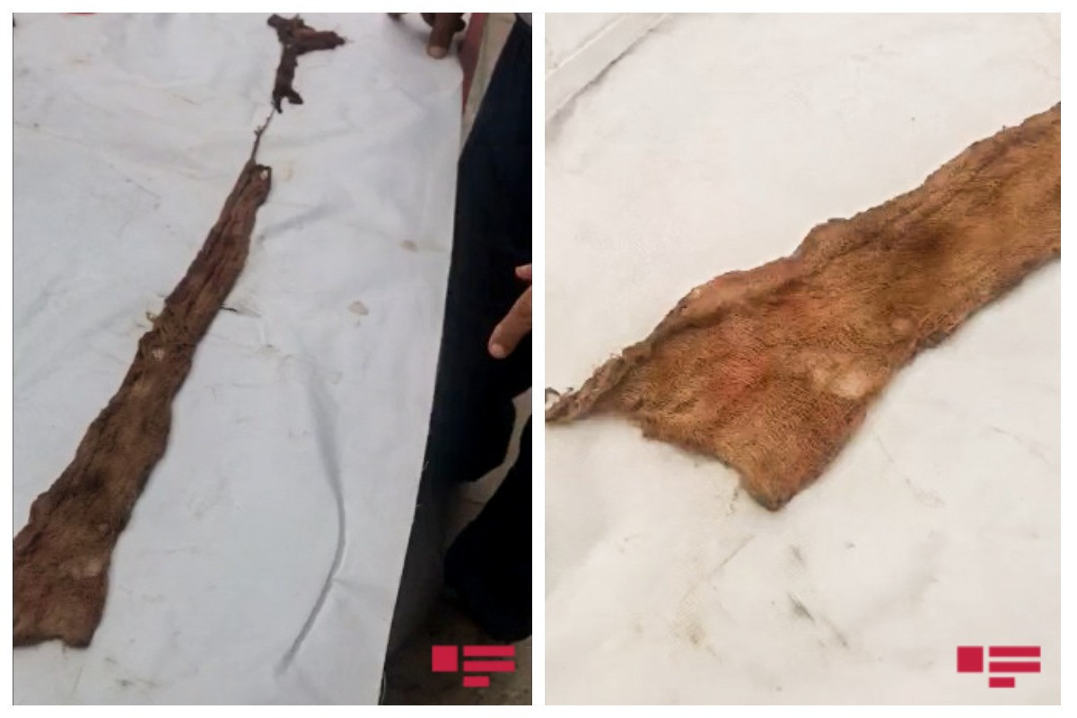 В желудке жителя Ширвана был обнаружен тампон