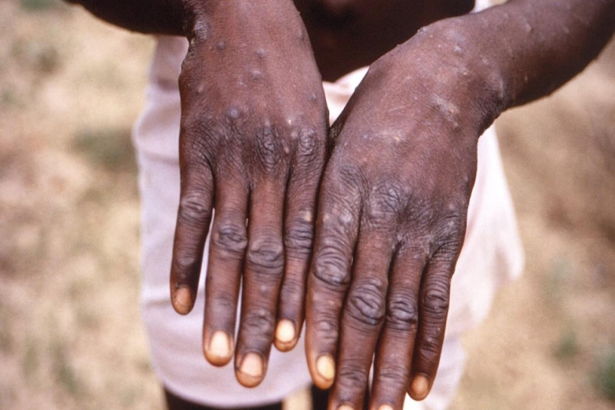 Iran records first case of monkeypox