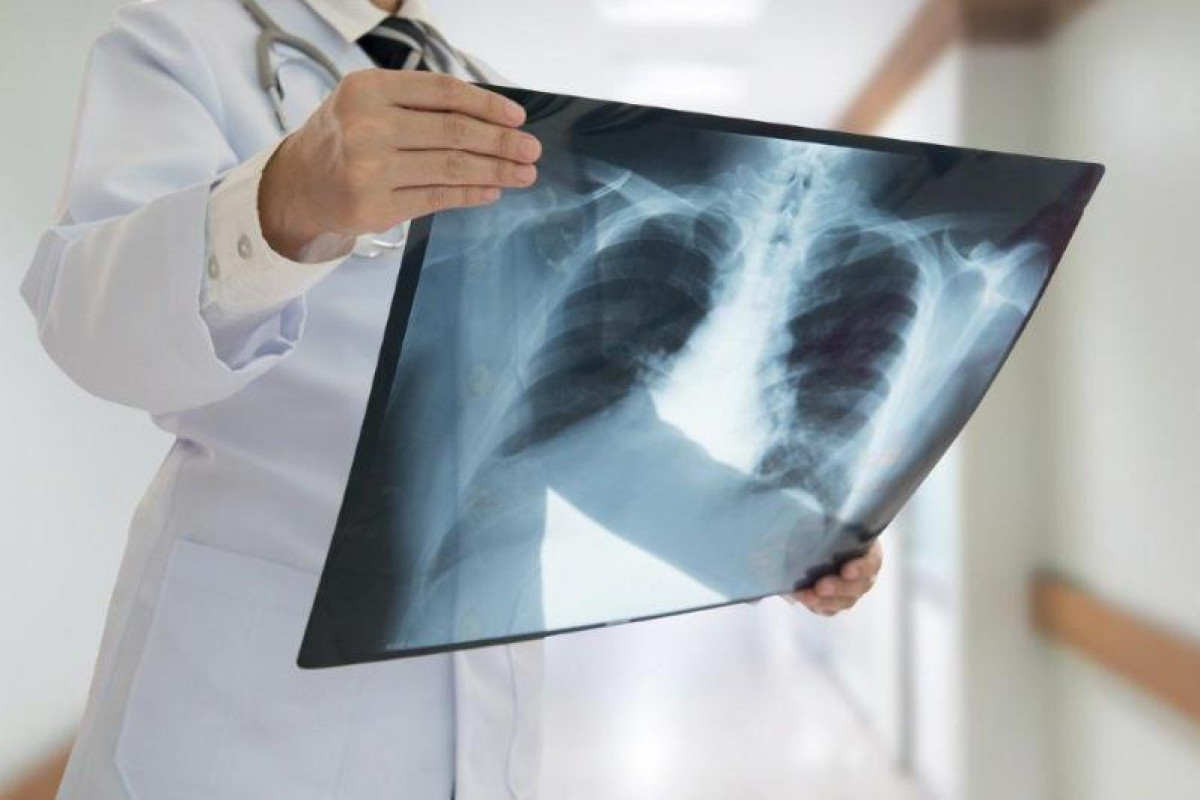 Kazakhstan adds 42 daily cases of COVID-19-like pneumonia