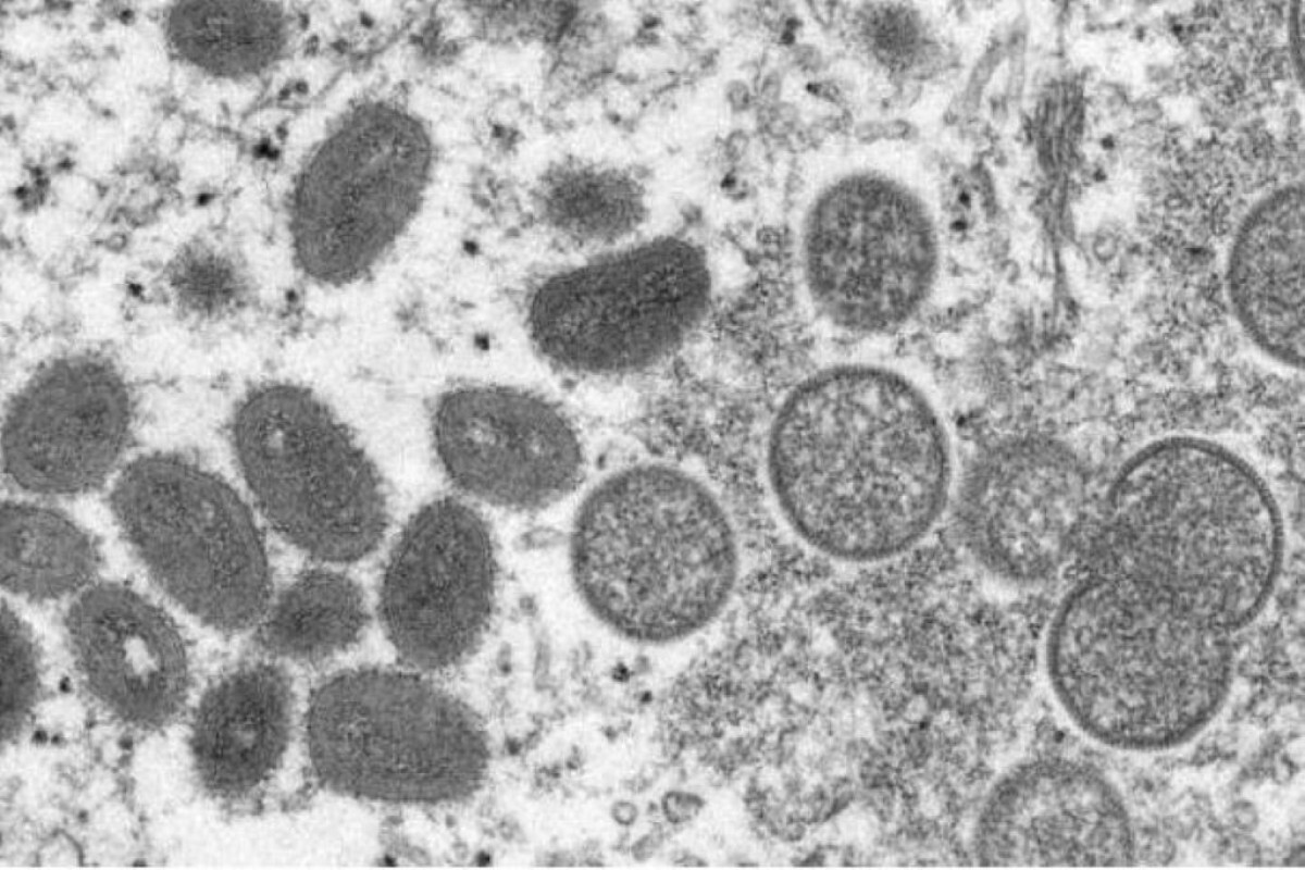 U.S. identifies first cases of monkeypox in children