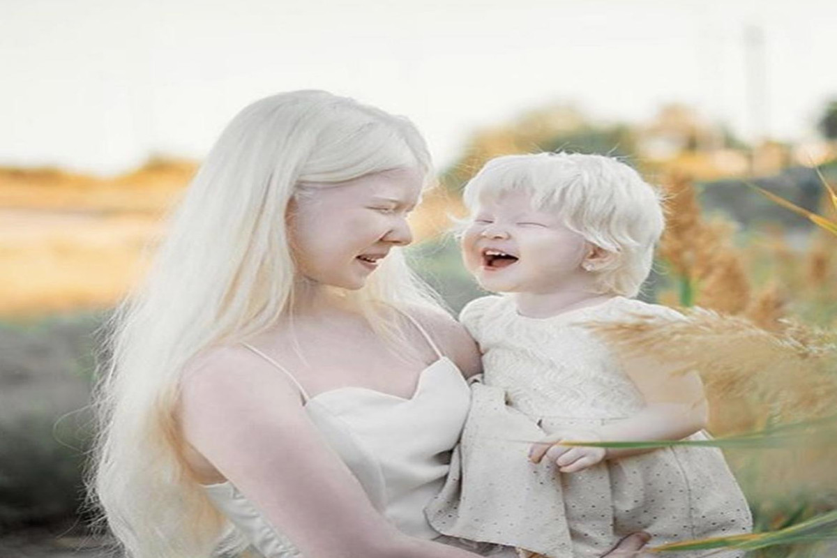 SN: "Uşağın albinos olması üçün hər iki tərəfdə bu genin olması lazımdır"