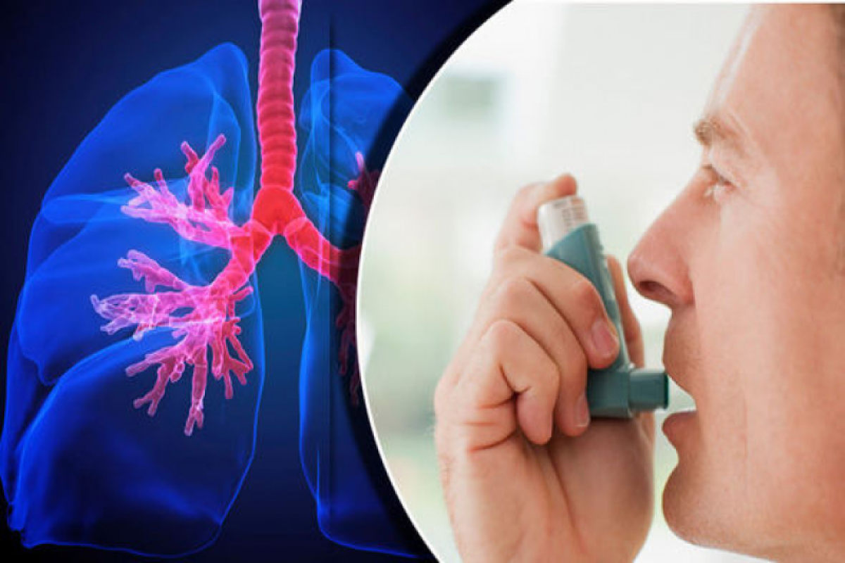Обнародовано число больных бронхиальной астмой в Азербайджане