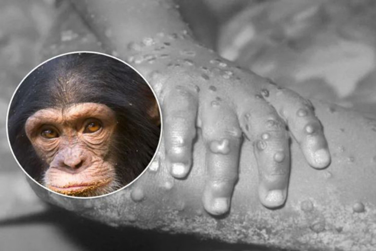 Во Франции выявлено 16 случаев заражения оспой обезьян