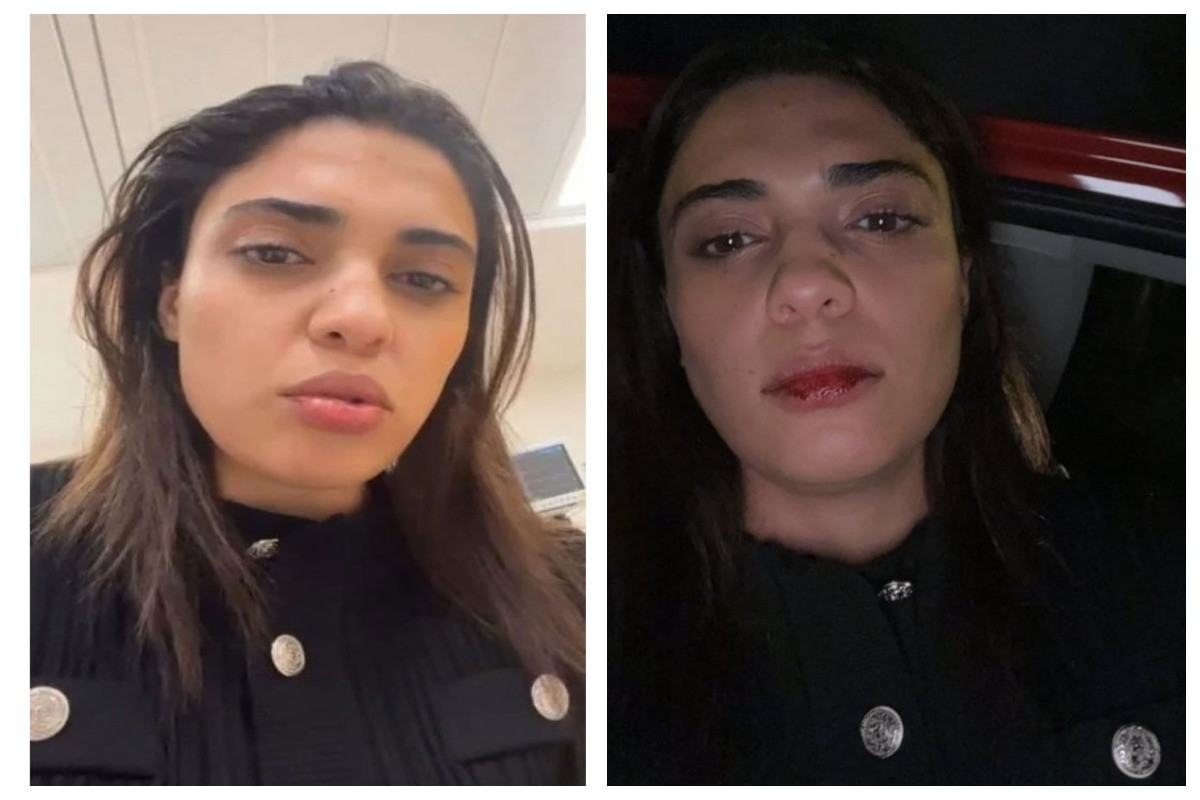 Azərbaycanlı müğənni İstanbulda taksi sürücüsü tərəfindən döyülüb