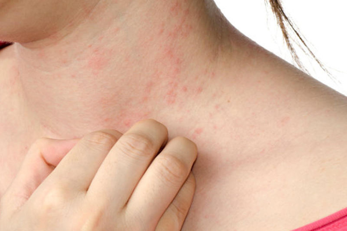 SN: Allergiyanı tamamilə müalicə etmək mümkün deyil