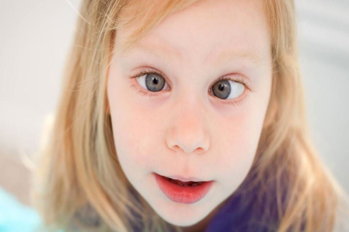 Ребенок косит глазки. Эзотропия сходящееся косоглазие. Косоглазие у детей. Косые глаза у детей. Косоглазие фото.