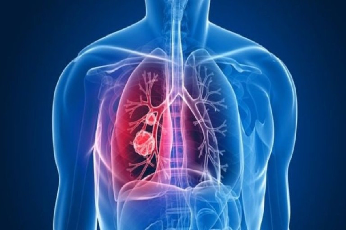В прошлом году в Азербайджане туберкулезом заболели около 3 тыс человек