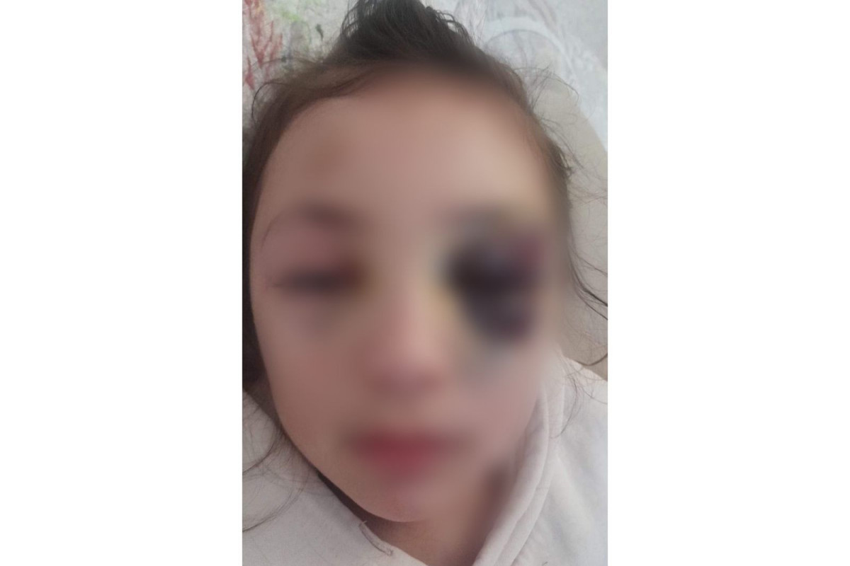 Prokurorluq Bakıda məktəblinin  xəsarət alması faktını araşdırır