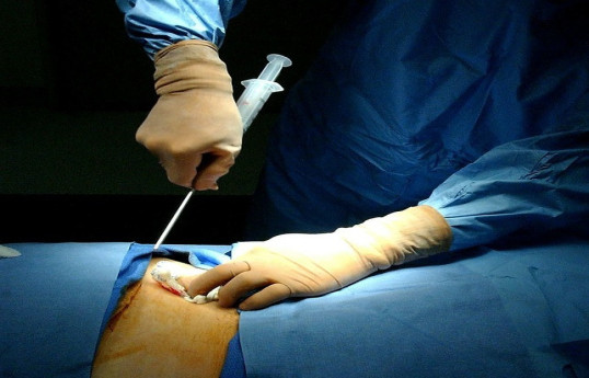 Sümük iliyi transplantasiyası cərrahi müdaxilə olmadan həyata keçiriləcək