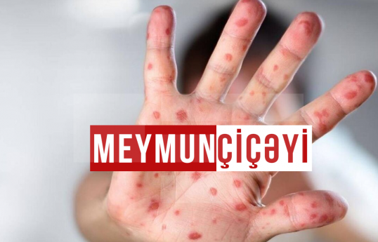 Azərbaycanda bu günə qədər meymunçiçəyinə şübhəli hallar qeydə alınmayıb  - RƏSMİ 