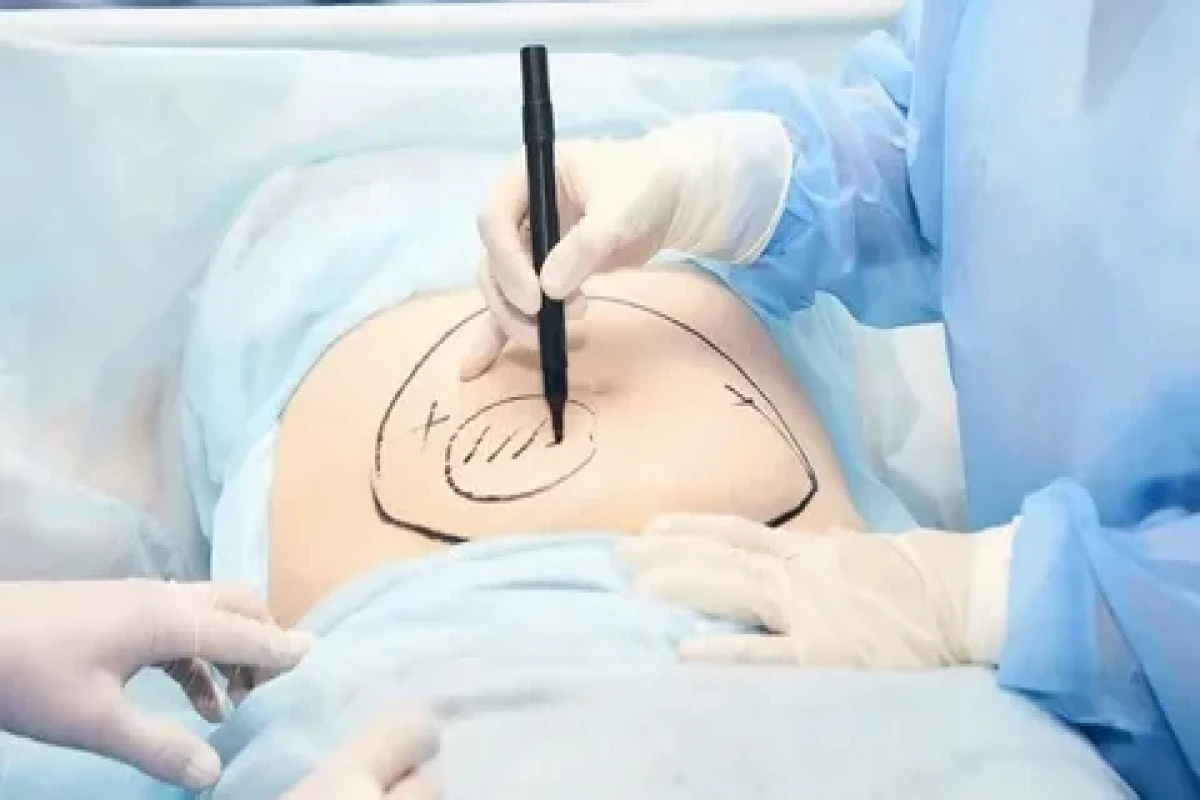 Sumqayıtda liposaksiya əməliyyatı etdirən 34 yaşlı qadın ölüb