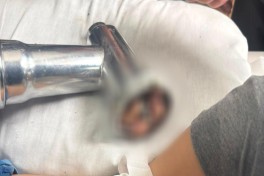 3 yaşlı uşağın ət maşınında ağır yaralanan əli 8 saatlıq mikrocərrahi əməliyyatla bərpa edilib - FOTO 