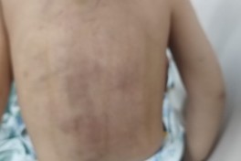 Lənkəranda 3 yaşlı uşağın atalığı tərəfindən döyüldüyü bildirilir, araşdırma başlanılıb - FOTO 